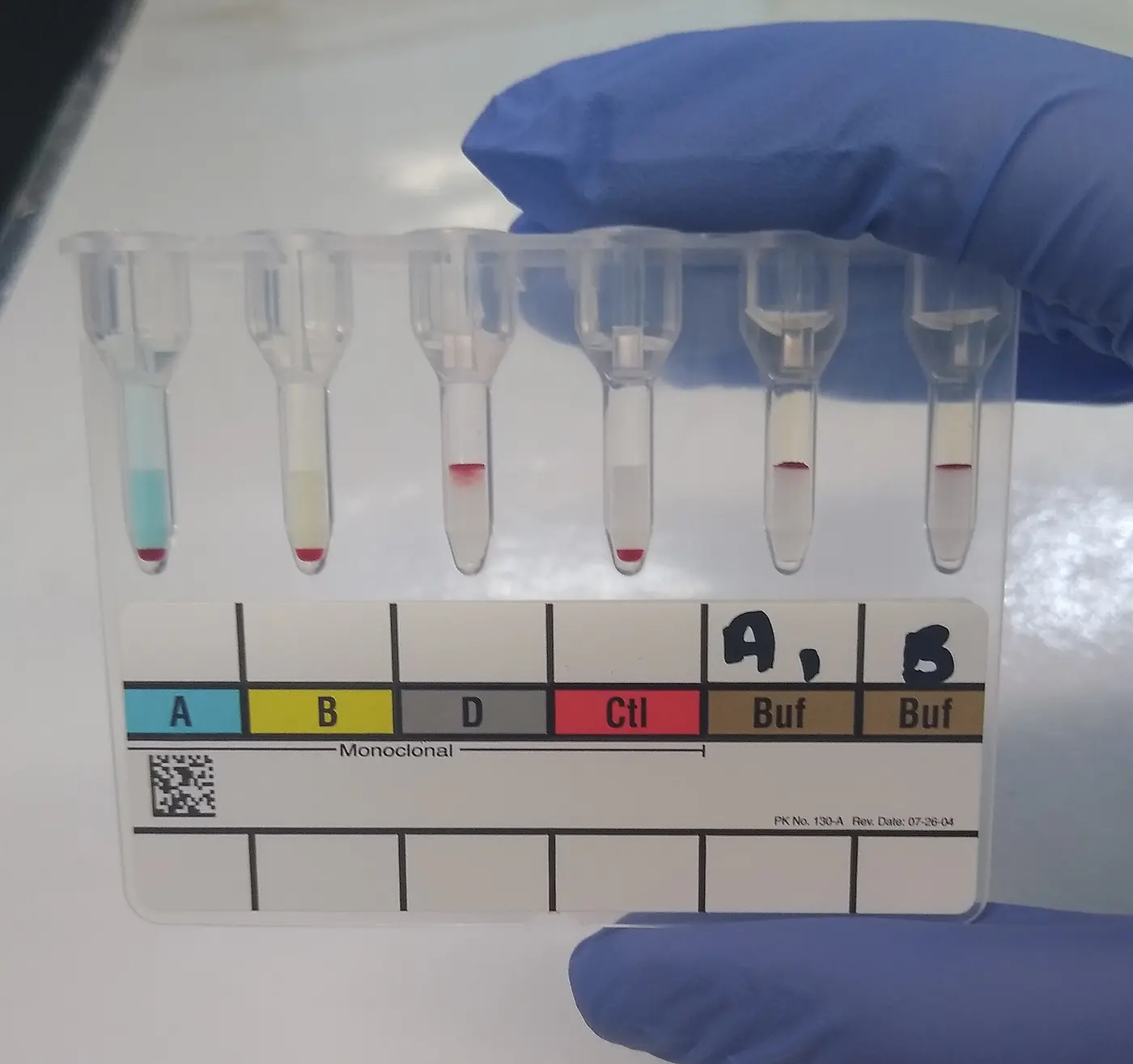 A gloved hand holding a clear gel card; in six thin tubes, red blood cells have either sunk to the bottom or stopped partway