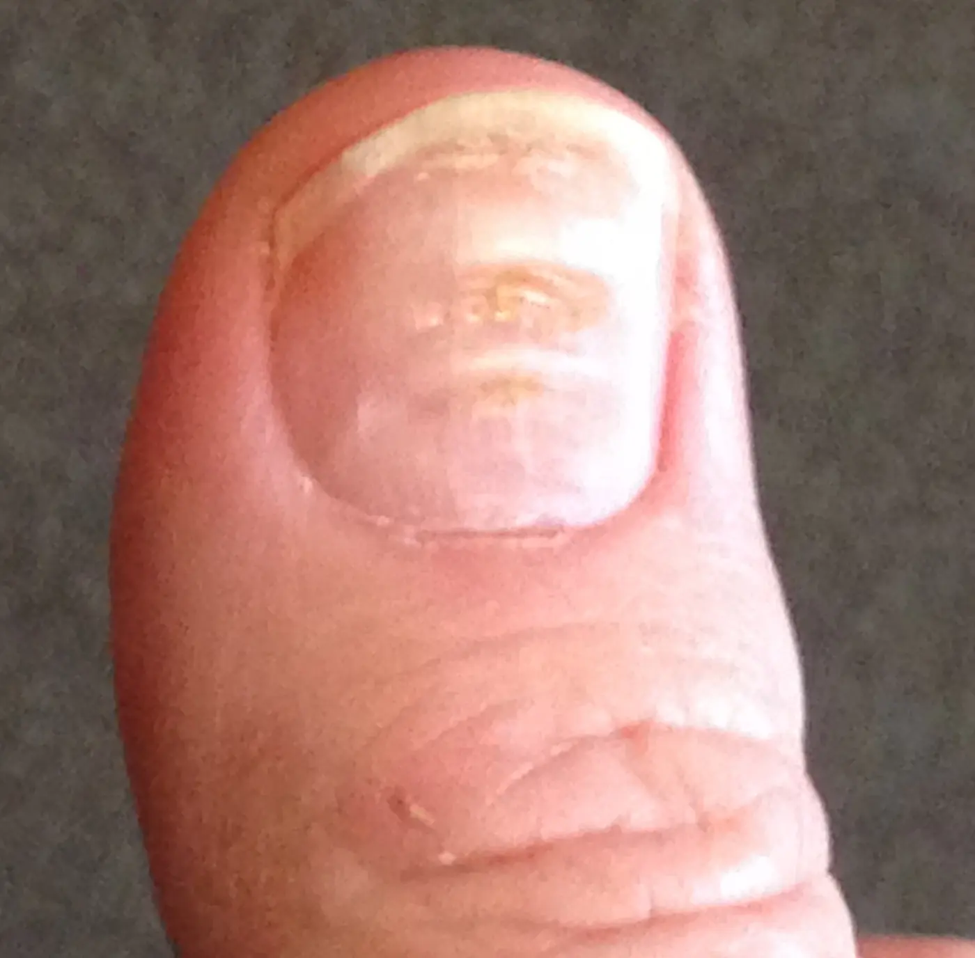 A thumbnail with several thin grooves running across its surface