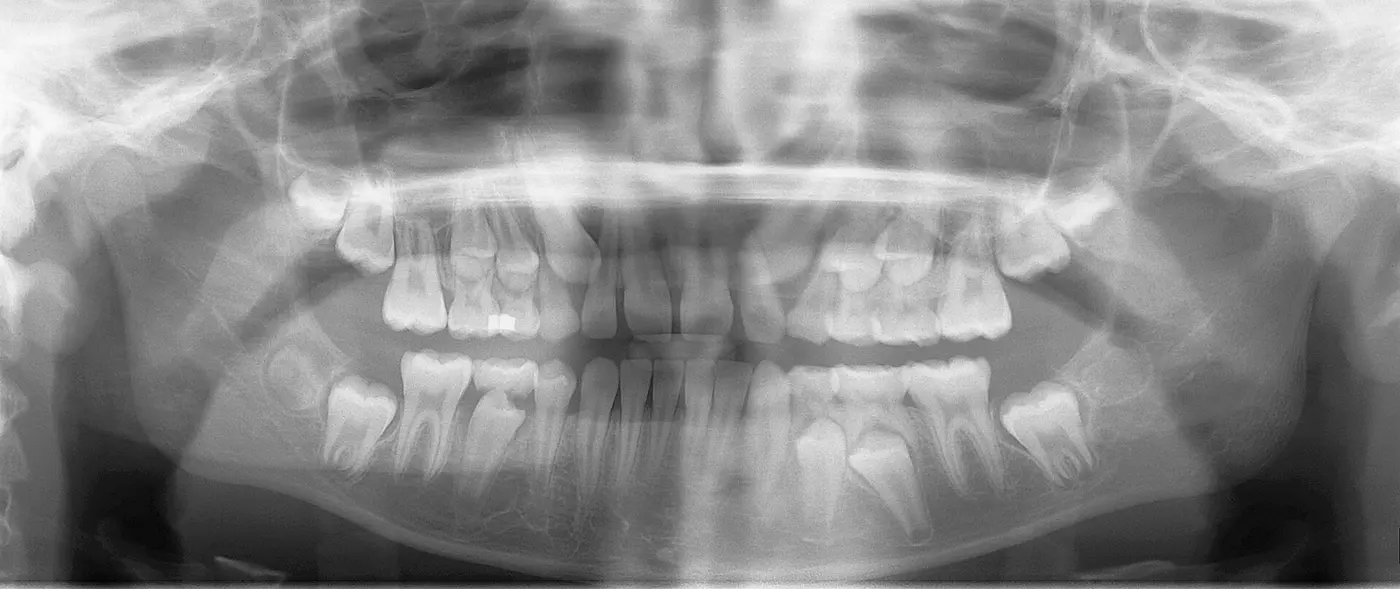 An X-ray of a child’s whole jaw, with permanent teeth visible beneath the baby teeth