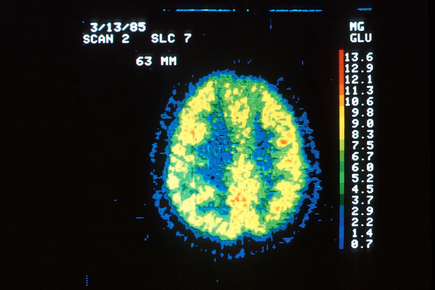 A cross-section of a brain shown in yellow, green and blue on a black screen