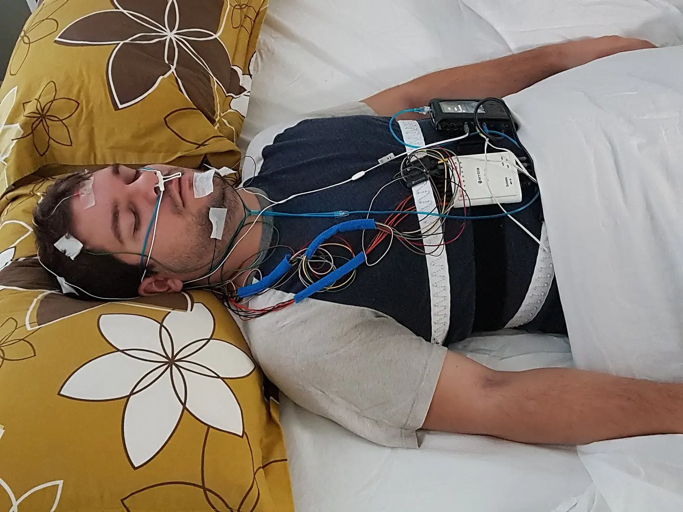A person sleeping with electrodes attached to the head and face to measure brain waves and other signals